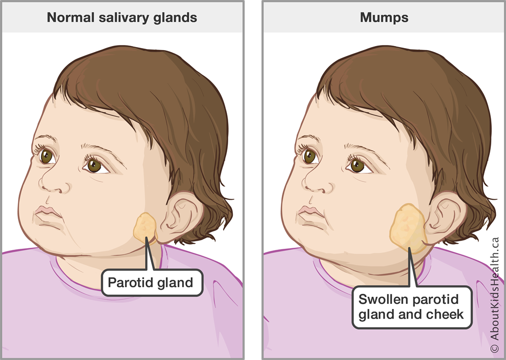 Mumps_MED_ILL_EN