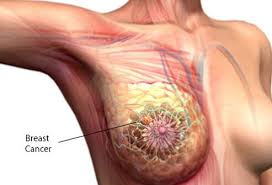 breast cance