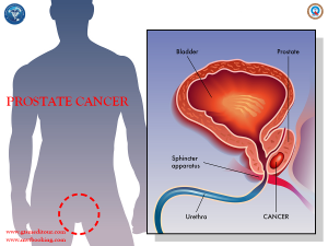 prostate cancer 2