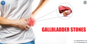 Gallbladder-Stones111